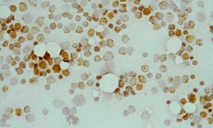Las alteraciones de unas proteínas detectarían casos de leucemia mieloide aguda que no responden a la terapia estándar